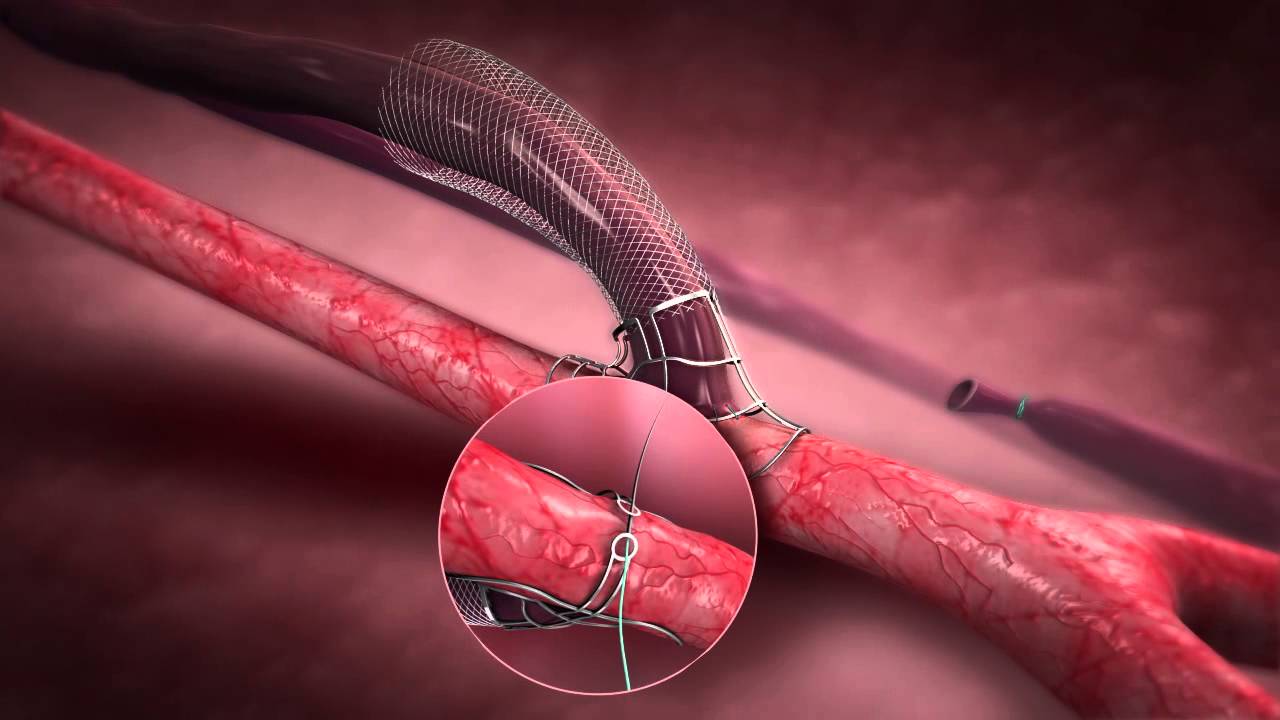 Laminate Medical Launches Study of VasQ Hemodialysis Fistula Device ...