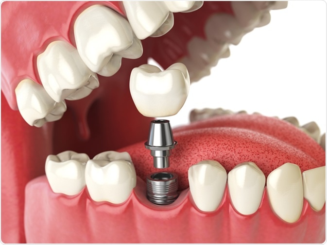 [عکس: dental_prosthetics_implants.jpg]