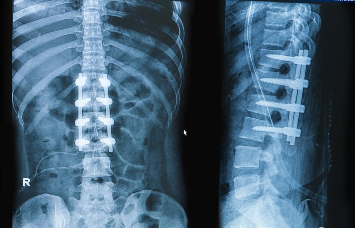 How Many Spinal Fusions Are Performed Each Year In The United States Idata Research