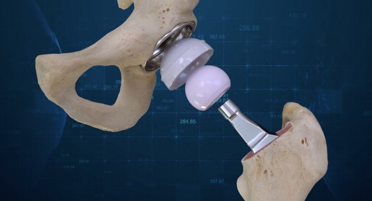 Conformis Announces the First 3D Total Hip Replacement Surgeries ...