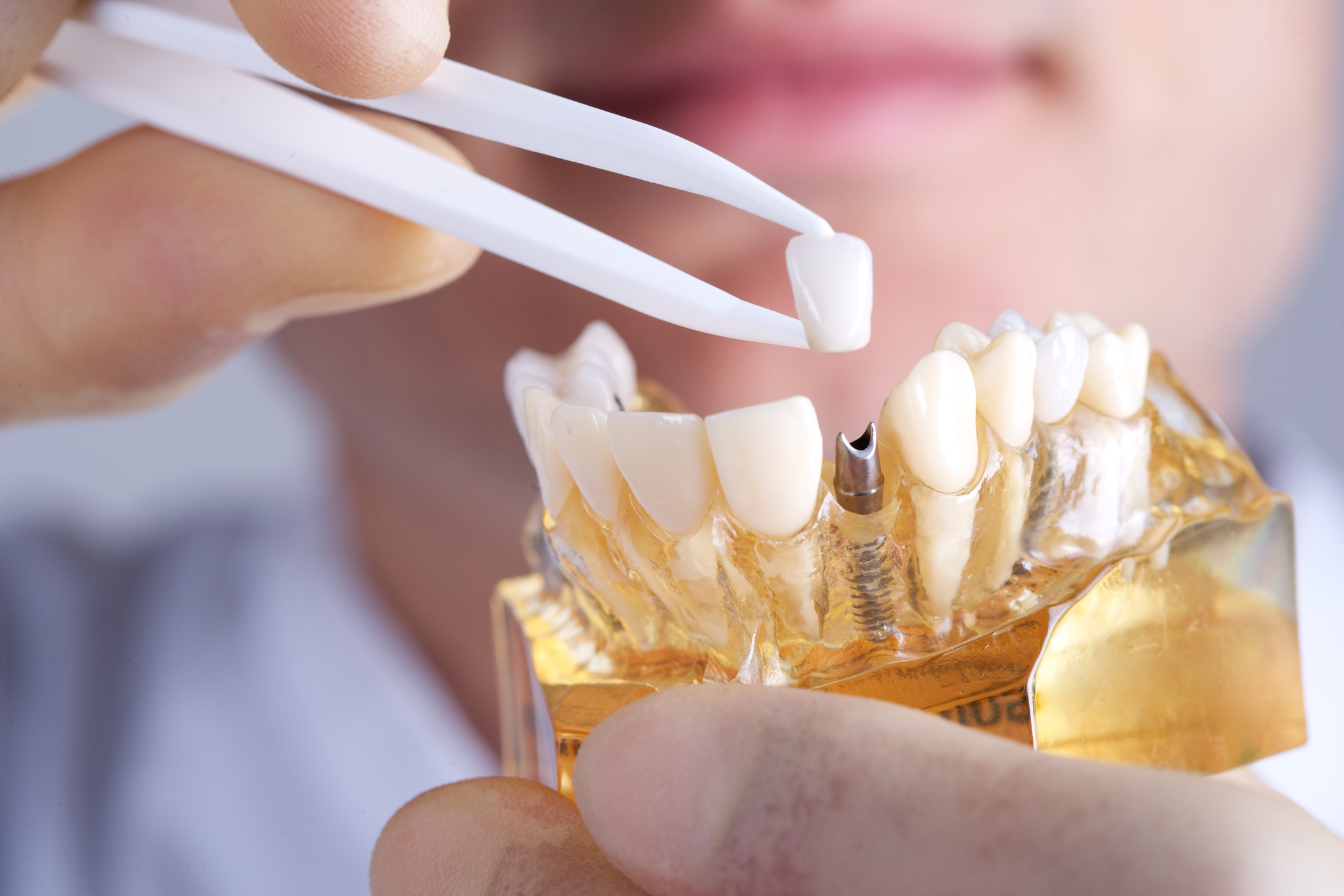 Dental Prosthetics Market in Australia to Pass $500 Million by 2024 - iData  Research