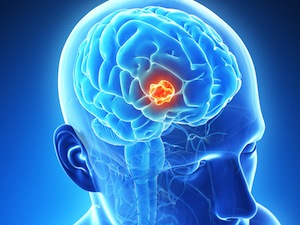 Brain Tumor Extracting Device Deemed FDA Breakthrough Device - iData  Research