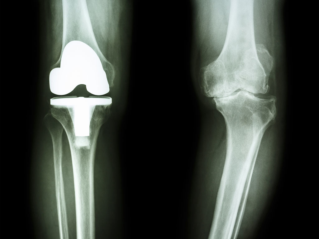 new research on knee replacements