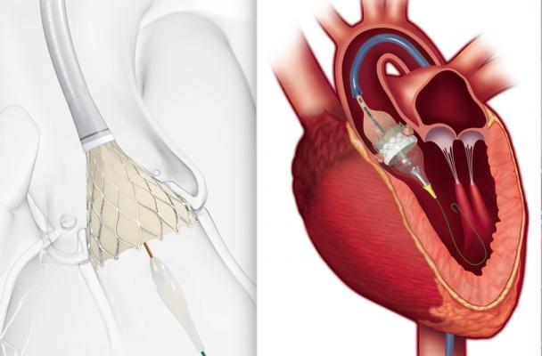 FDA Approves TAVR Systems to Younger, LowRisk Heart