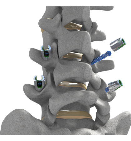 DeGen Medicals Minimally Invasive Surgical Procedure - iData Research