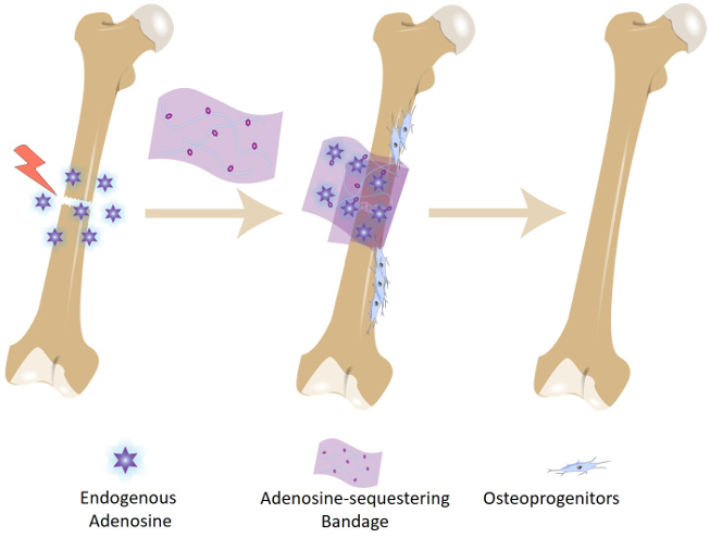 Bone Bandage Soaks up Adenosine Molecules to Speed Up Repair