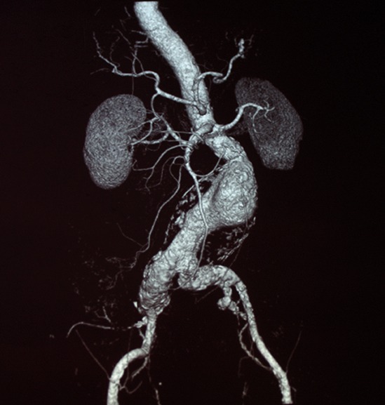 aortic aneurysm fenestrated graft stent