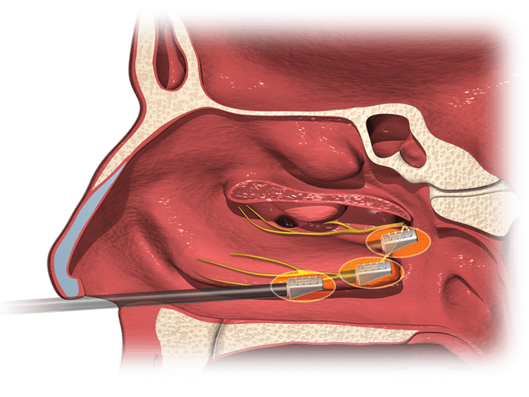 Aerin Medical Wins FDA Approval for Nonsurgical Chronic Rhinitis