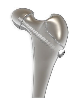 OrthoPediatrics Launches Large Fragment Cannulated Screw System