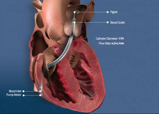 FDA Grants Emergency Use Authorization To Abiomed For Impella RP