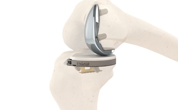 Engage Surgical has gained FDA approval for its Engage Partial Knee system, making it the only cementless partial knee system