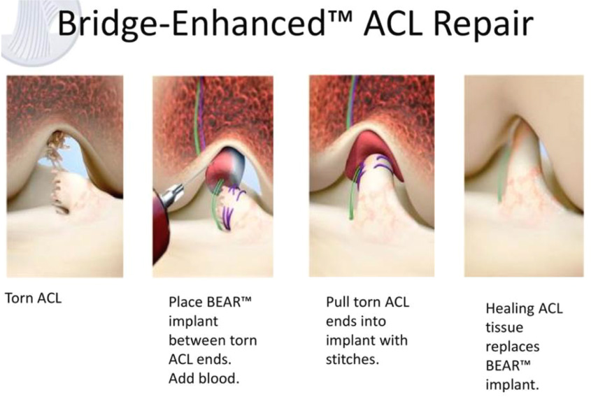 acl-tear-non-surgical-management-course-theory-global-specialist